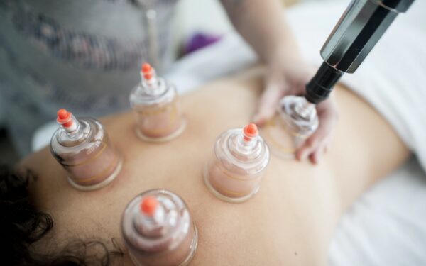 Cupping acupuncture method