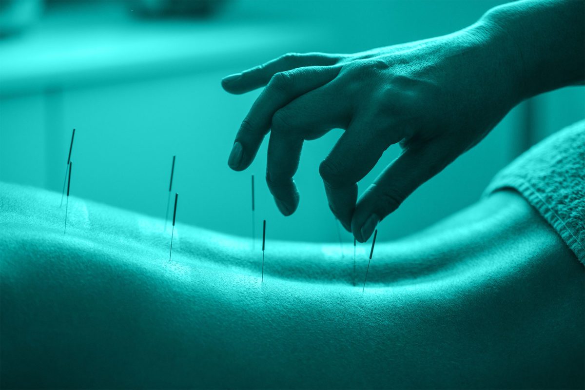 Acupuncture for Peripheral Neuropathy Elysian Wellness Centre