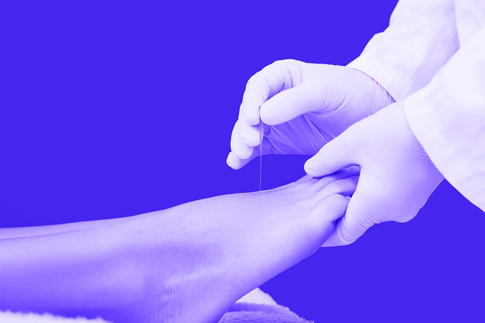 Acupuncture for Peripheral Neuropathy Elysian Wellness Centre