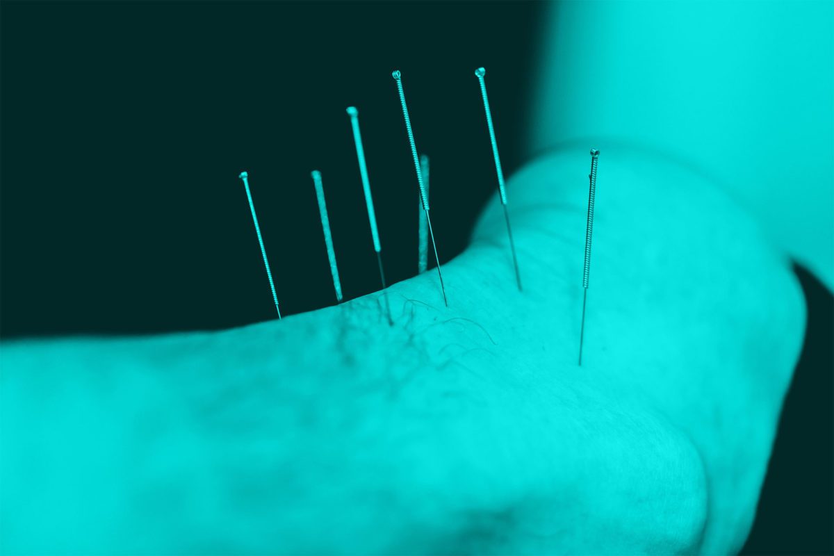 Acupuncture for Peripheral Neuropathy Elysian Wellness Centre