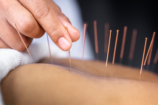 acupuncture needs in skin