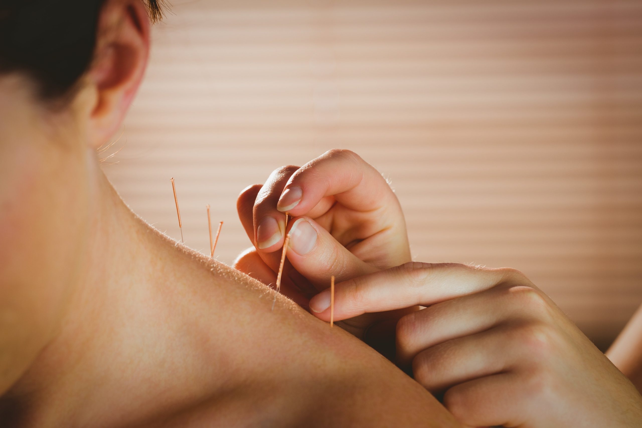 woman receiving acupuncture